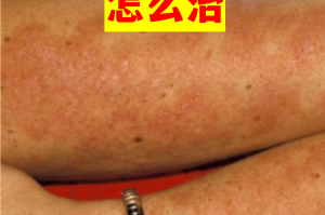 “四川新增省内感染者30例” 四川新增感染者的症状？