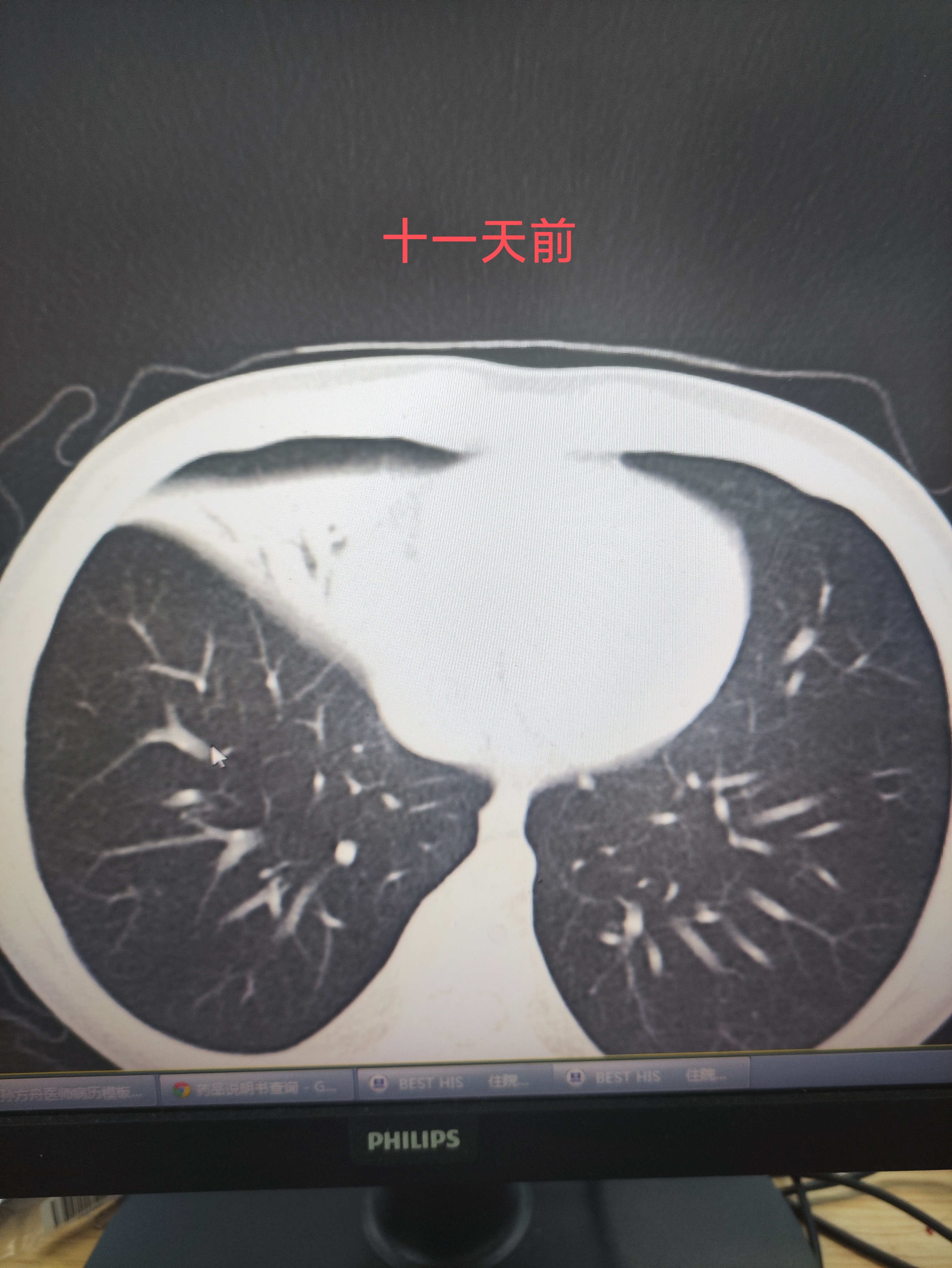 【河北保定发现一例/河北保定发现一例新型肺炎患者】-第1张图片