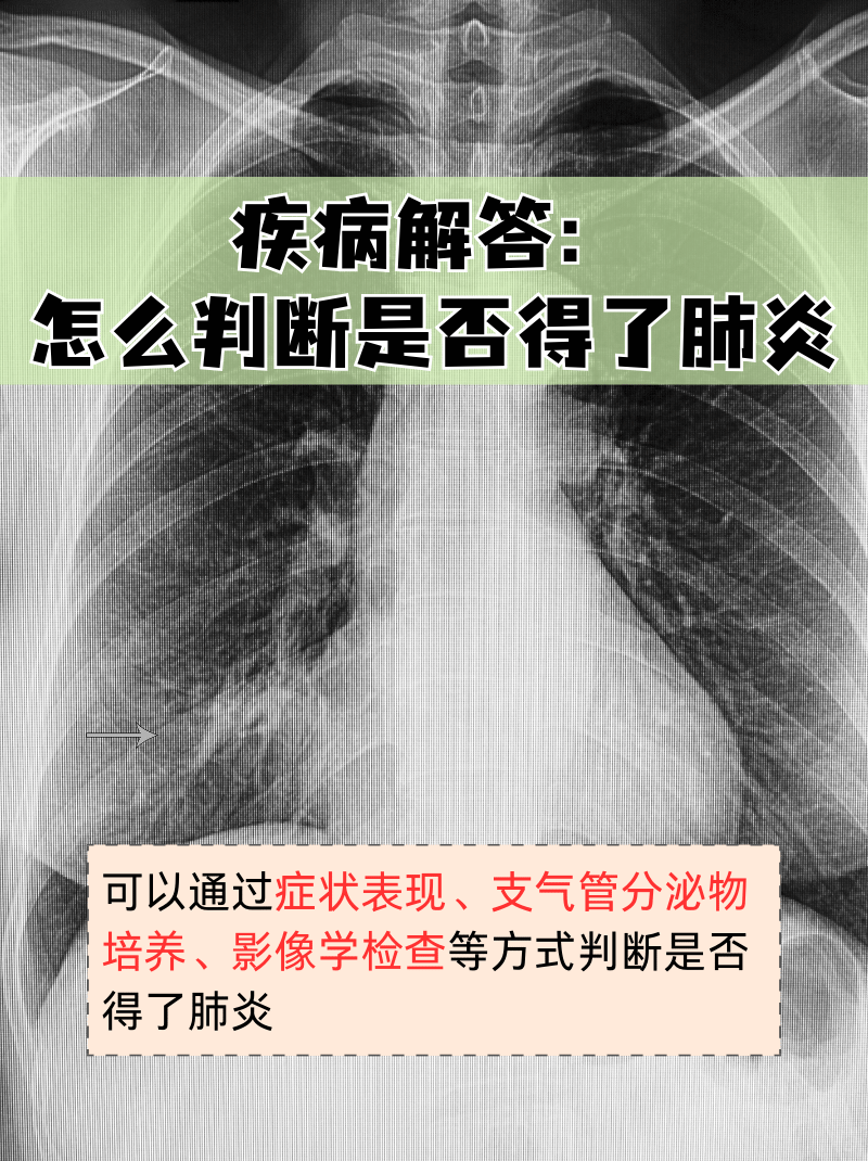“肺炎今天新闻最新	” 今天肺炎新消息？-第3张图片