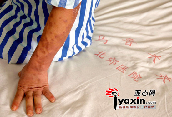 新疆确诊〃新疆确诊艾滋病患者-第2张图片